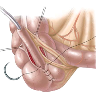 ace surgery