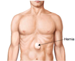 Hernia at epigastric region