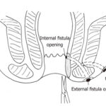 fistulectomy surgery