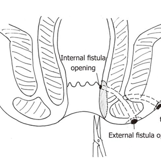 fistulectomy surgery