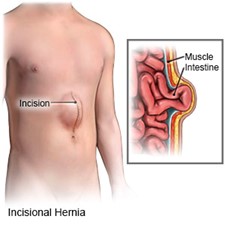 post surgery hernia