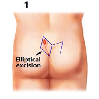 Rhomboid Flap