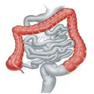 subtotal colectomy