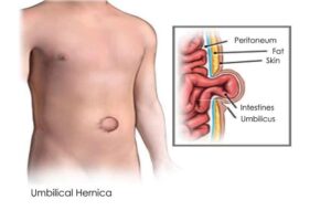 Hernia at umbilicus 
