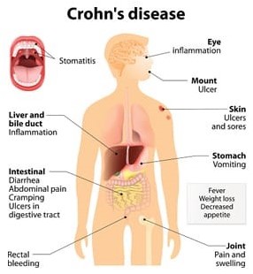 Crohns Disease