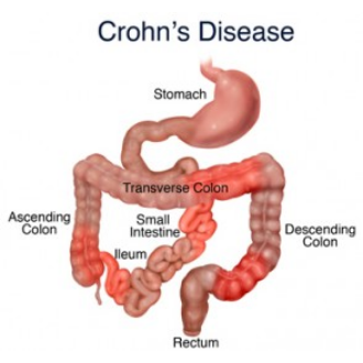 Crohns