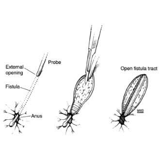 Fistulotomy surgery
