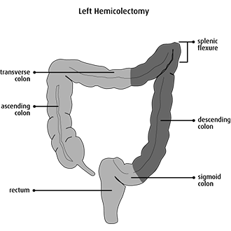 hemicolectomy
