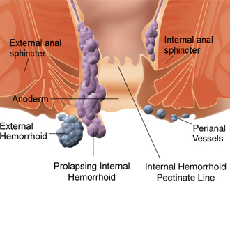 Injection Sclerotherapy piles