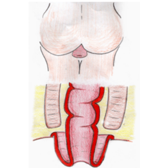 Rectal Prolapse