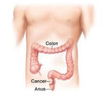 Laparoscopic Anterior Resection