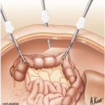 Colon Cancer