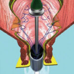 Obstructed defecation Syndrome