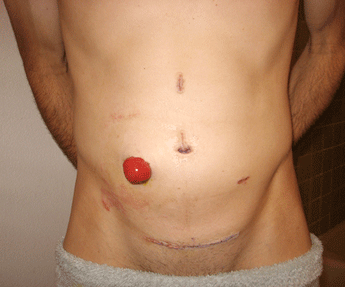 Stoma care